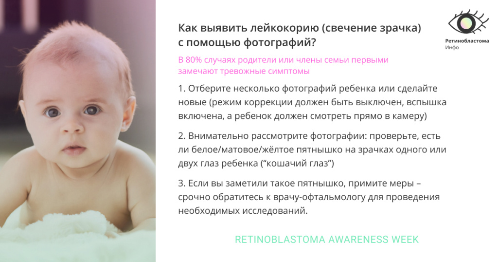 Иллюстрация 1. Как выявить лейкокорию на фото.jpg